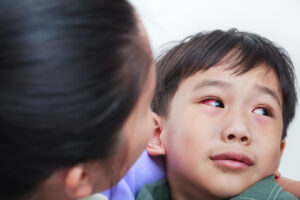 Closeup of child with conjunctivitis with a red iris